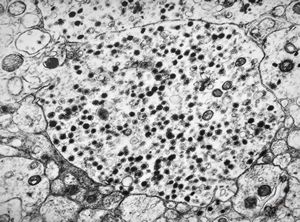 M,3y. | neuroblastoma - adrenal